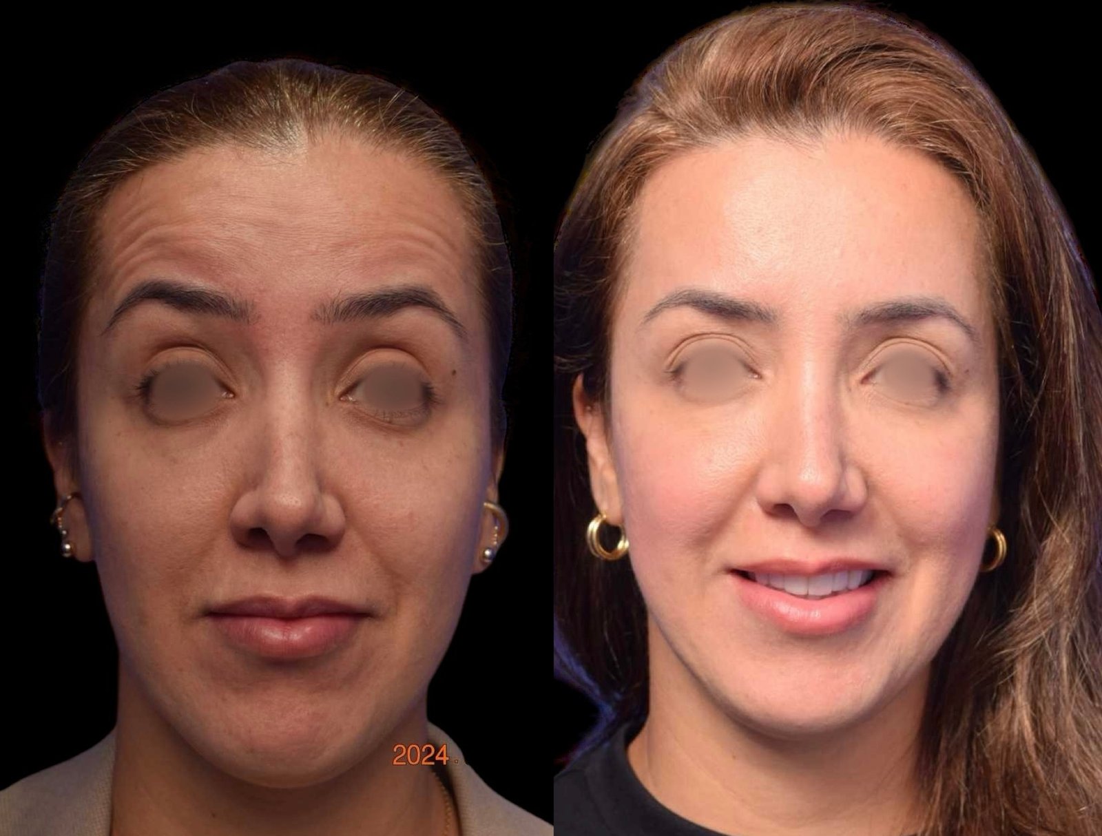Botox