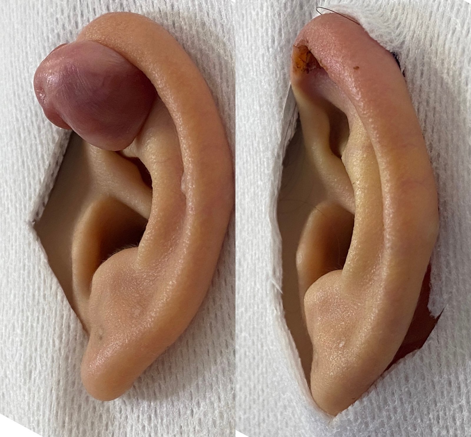 Queloide
